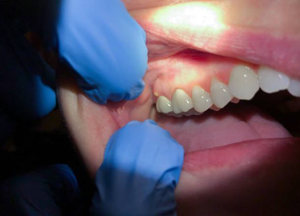 Best Emergency Treatment for Toothache in Castlewood, VA